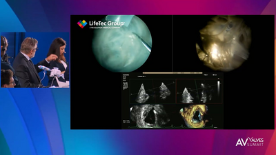 Inside the Right Heart | Tricuspid focus